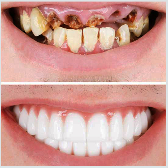 prima e dopo gli impianti dei denti