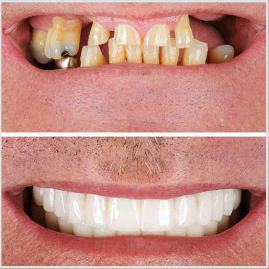 fotos de dientes de implante dental