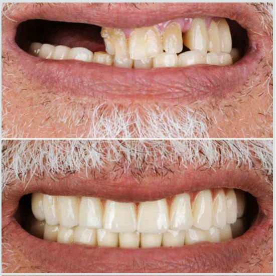 Implantes dentales antes y después.