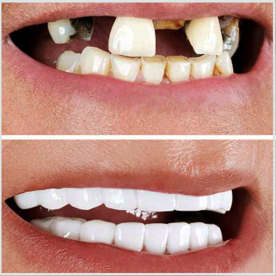 4 faccette sui denti anteriori prima e dopo
