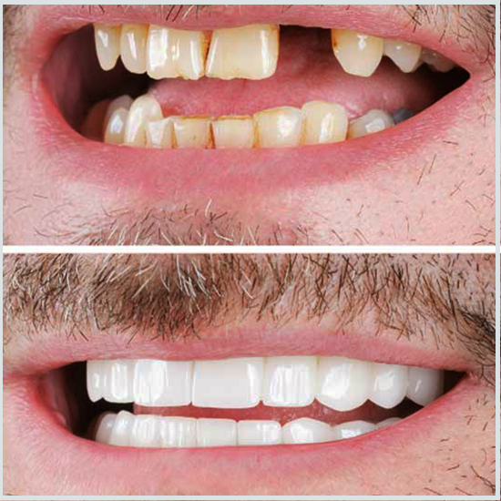 Imágenes de implantes dentales.