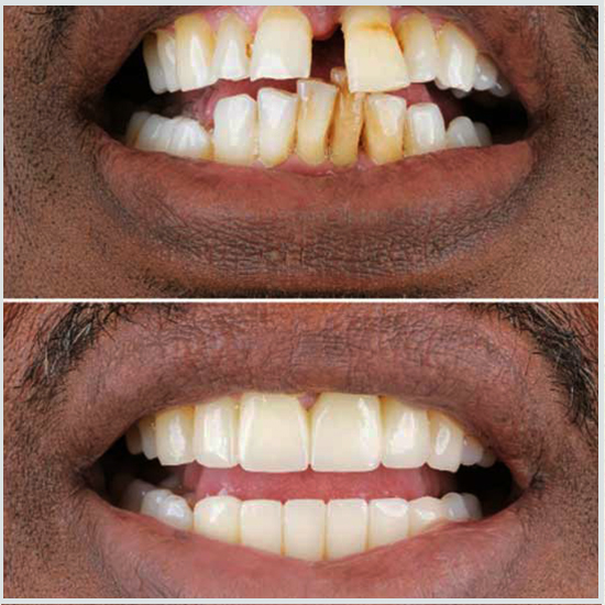 imágenes de implantes dentales