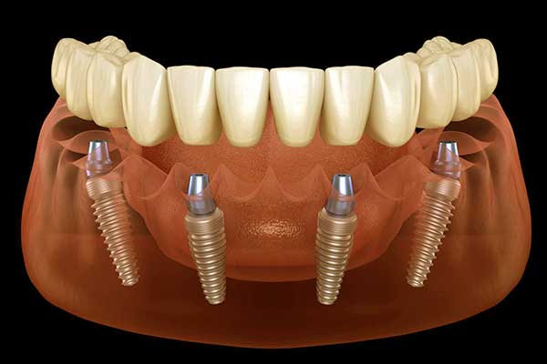 Implantes dentales All-on-6