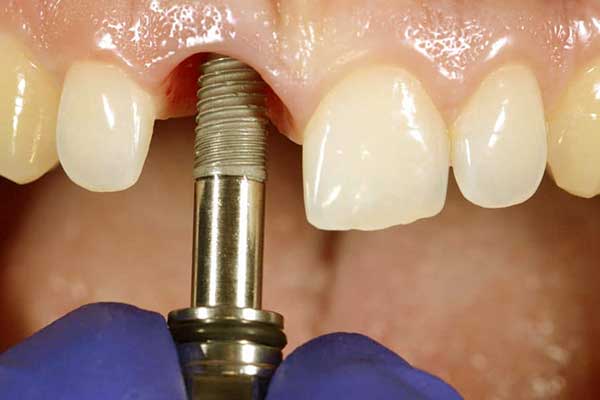 Implante dental único