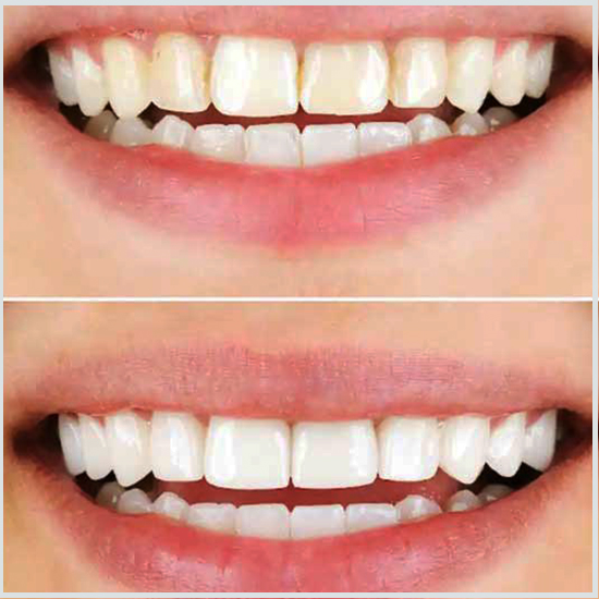 puente dental antes y despues