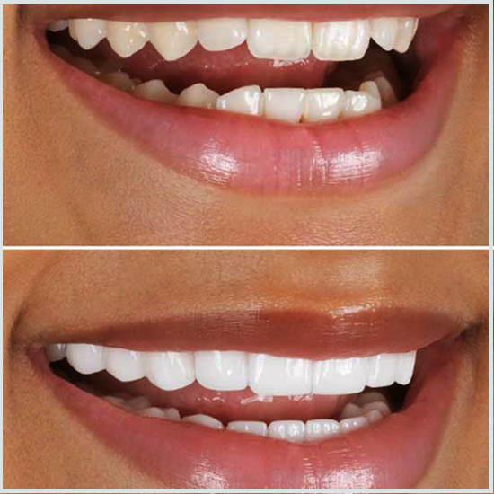 antes y después de la dentadura postiza