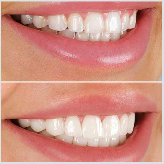 Coronas de dientes frontales antes y después.