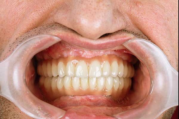 implantes dentales de boca completa