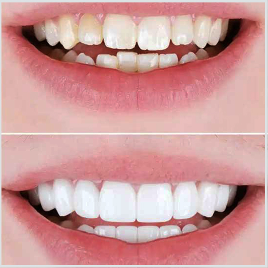 coronas dentales antes y despues
