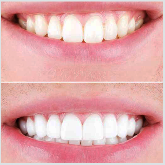 resultados del blanqueamiento dental antes después