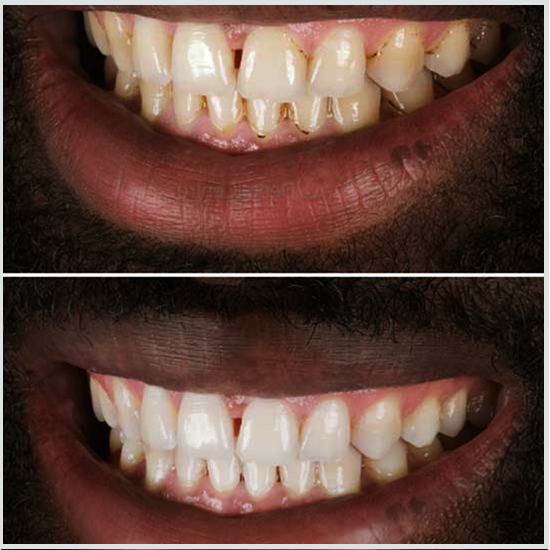 veneer before and after