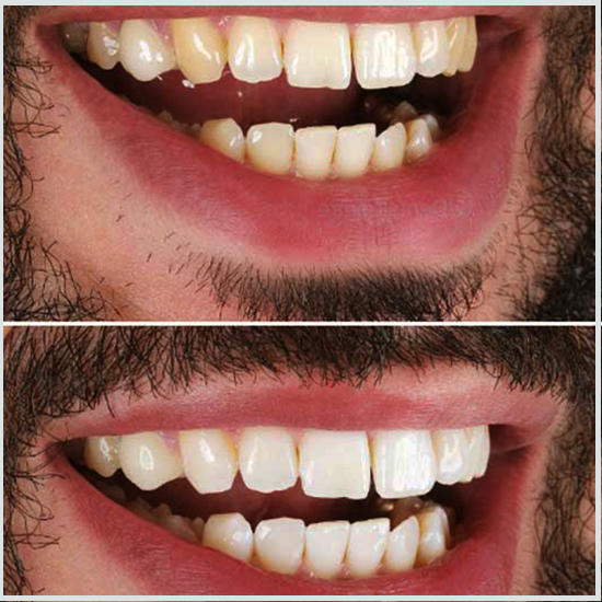 dientes adheridos antes y después