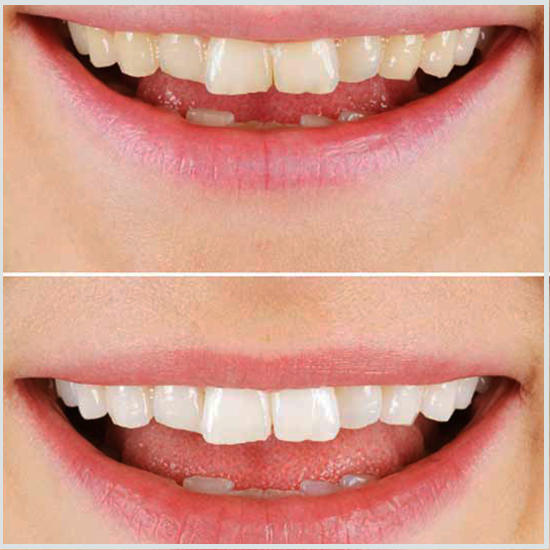 dientes blanqueados antes y despues