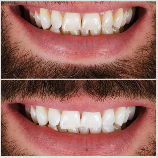 blanqueamiento dental antes y después