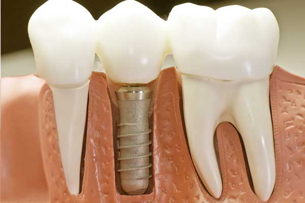 Implante dental todo en 4