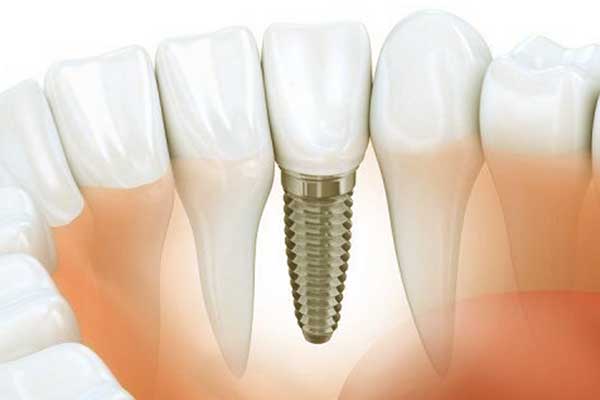3 sobre 6 implantes dentales