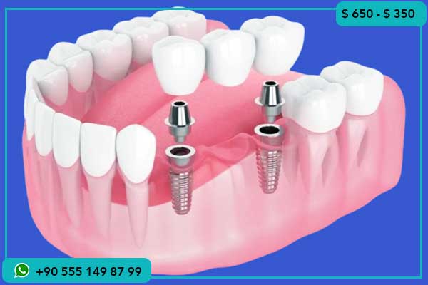 أسعار زراعة الأسنان في ألمانيا , أسعار زراعة الأسنان في ألمانيا وتركيا ولماذا تختار تركيا, الفرق بين أسعار زراعة الأسنان في ألمانيا وتركيا, تكلفة زراعة الأسنان في تركيا وألمانيا, لماذا تعتبر تركيا الوجهة المثالية لزراعة الأسنان, مقارنة بين أسعار زراعة الأسنان في تركيا وألمانيا