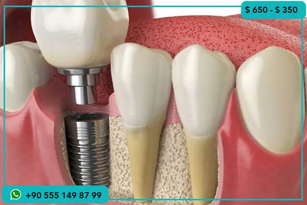 الفرق بين أسعار زراعة الأسنان في قطر وتركيا, تكلفة زراعة الأسنان في تركيا, أسعار زراعة الأسنان في قطر, زراعة الأسنان في تركيا ولماذا تختارها, أفضل مراكز زراعة الأسنان في تركيا, زراعة الأسنان في قطر مقارنة بتركيا, تكلفة الإقامة أثناء زراعة الأسنان في تركيا, السياحة العلاجية في تركيا للأسنان, تجارب زراعة الأسنان في تركيا, أنواع زراعة الأسنان في تركيا