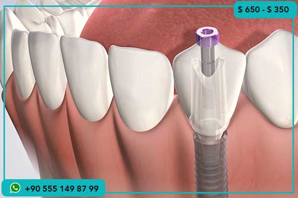 الفرق بين أسعار زراعة الأسنان في الأردن وتركيا, أسعار زراعة الأسنان في تركيا, أسعار زراعة الأسنان في الأردن, لماذا تختار زراعة الأسنان في تركيا, تكاليف زراعة الأسنان في تركيا والأردن, زراعة الأسنان في تركيا مقارنة بالأردن, زراعة الأسنان في تركيا للسياحة العلاجية