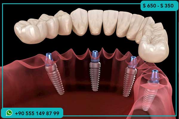 أسعار زراعة الأسنان في الإمارات, أسعار زراعة الأسنان في تركيا, تكلفة زراعة الأسنان في الإمارات وتركيا, زراعة الأسنان في تركيا 2024, تكلفة زراعة الأسنان في دبي, زراعة الأسنان الكاملة في تركيا, مقارنة أسعار زراعة الأسنان الإمارات تركيا, زراعة الأسنان في إسطنبول, الفرق بين زراعة الأسنان والتركيب, زراعة الأسنان بأسعار معقولة, زراعة الأسنان السياحة العلاجية تركيا