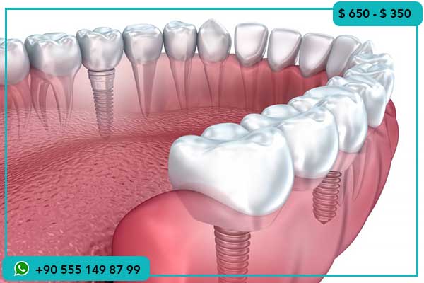 الفرق بين أسعار زراعة الأسنان في السعودية وتركيا, زراعة الأسنان في تركيا 2024, أسعار زراعة الأسنان في السعودية, تكلفة زراعة الأسنان في تركيا, مقارنة زراعة الأسنان السعودية تركيا, أسعار زراعة الأسنان منخفضة تركيا, جودة زراعة الأسنان في تركيا, السياحة العلاجية في تركيا, مراكز زراعة الأسنان في إسطنبول, مركز التجميل الدولي لزراعة الأسنان