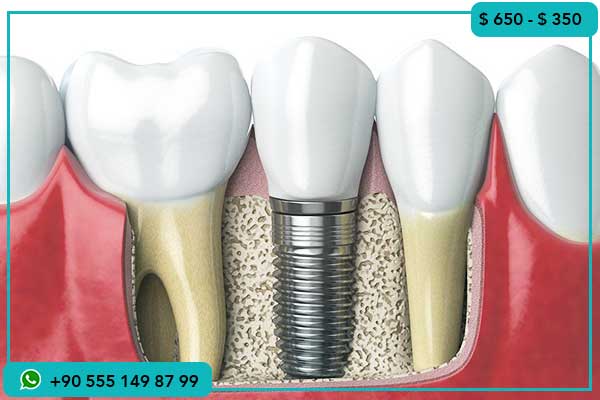 أسعار زراعة الأسنان في العراق , الفرق بين أسعار زراعة الأسنان في العراق وتركيا, تكلفة زراعة الأسنان في تركيا, أسعار زراعة الأسنان في العراق, لماذا تختار تركيا لزراعة الأسنان, زراعة الأسنان في تركيا بالتفصيل, أفضل مراكز زراعة الأسنان في تركيا, تجارب زراعة الأسنان في تركيا, السياحة العلاجية في تركيا, أسعار زراعة الأسنان مقارنة بين الدول, زراعة الأسنان بالتقنيات الحديثة