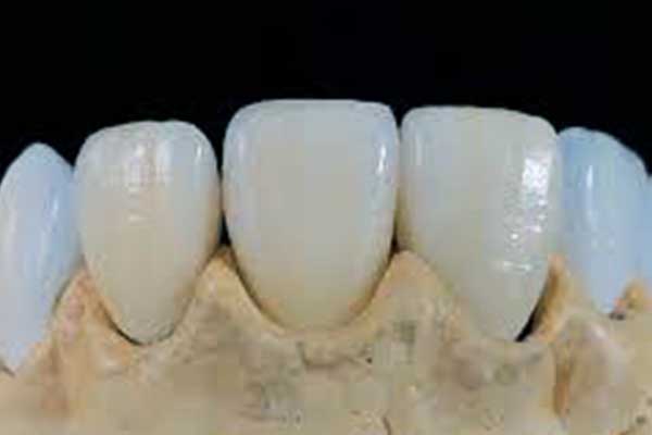 dental veneers in Turkey, affordable dental veneers in Turkey, best clinics for veneers in Turkey, Turkey dental veneers cost, porcelain veneers Turkey, E-max veneers in Turkey, composite veneers in Turkey, Lumineers in Turkey, dental veneer procedure in Turkey, Turkey dental tourism, cosmetic dentistry in Turkey, best Turkish dentists for veneers, Hollywood smile Turkey, dental veneers before and after Turkey, getting veneers abroad, full set veneers Turkey, Turkish dental veneer reviews, dental veneer packages Turkey , dental veneers, veneers Turkey, Turkey cosmetic dentistry, smile makeover Turkey, cheap veneers Turkey, top veneer clinics Turkey, dental aesthetics Turkey, dental care Turkey, best veneer deals Turkey, teeth transformation Turkey, dental veneer cost comparison, international dental treatments , how much do veneers cost in Turkey, best place to get veneers in Turkey, are Turkish veneers good quality, how long do veneers last in Turkey, is it safe to get veneers in Turkey, do veneers hurt in Turkey, how long does it take to get veneers in Turkey, what type of veneers are best in Turkey, is Turkey a good place for veneers, why is Turkey cheaper for veneers, does Turkey offer dental veneer packages, what are the benefits of veneers in Turkey