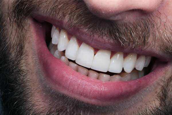 Quanto Costano le Faccette Dentali in Turchia