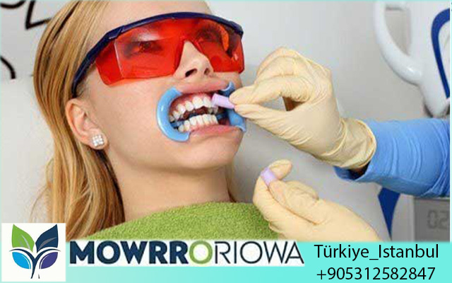 Costo degli Impianti Dentali in Turchia