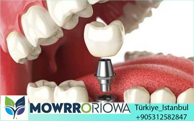 Migliore Clinica Dentistica in Turchia
