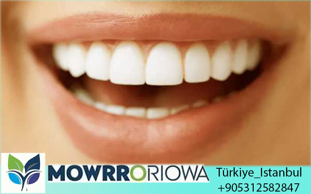 Impianti Dentali in Turchia Prezzi 2025: Guida Completa per Risparmiare fino al 70%