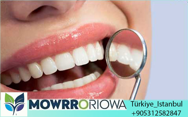 Faccette Dentali in Turchia Prezzi 2026: La Guida Completa per Risparmiare fino al 70% sul Tuo Sorriso da Star